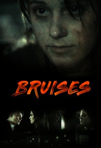 Bruises